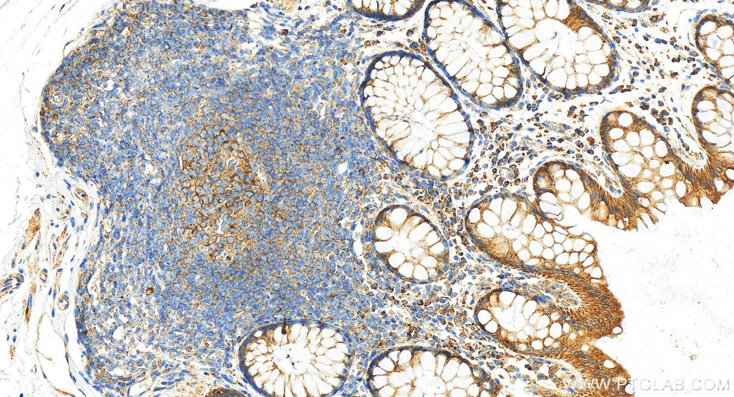 Immunohistochemistry (IHC) staining of human colon tissue using Cofilin 2 Polyclonal antibody (11848-1-AP)