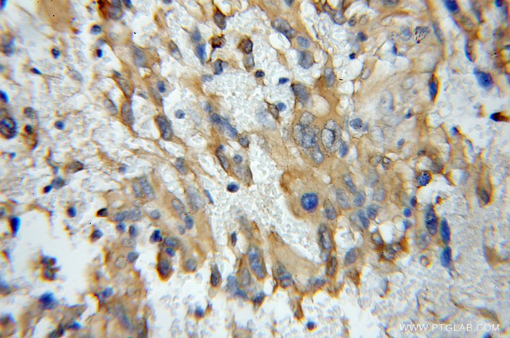 Immunohistochemistry (IHC) staining of human gliomas tissue using Cofilin 2 Polyclonal antibody (11848-1-AP)