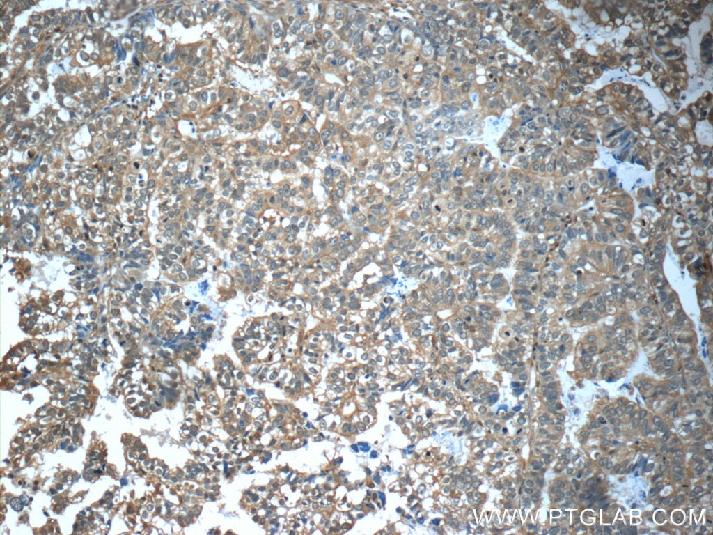 Immunohistochemistry (IHC) staining of human breast cancer tissue using CFTR Polyclonal antibody (20738-1-AP)