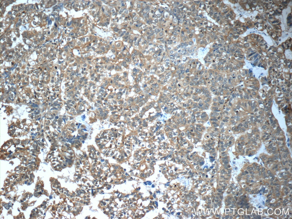 IHC staining of human breast cancer using 20738-1-AP