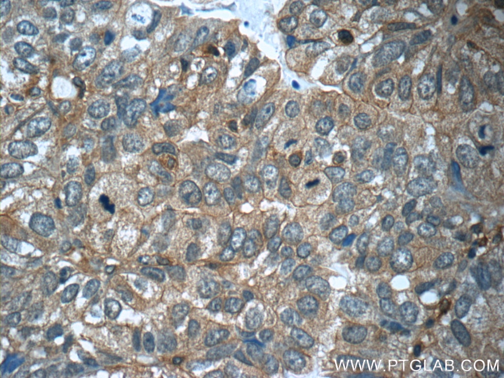 Immunohistochemistry (IHC) staining of human breast cancer tissue using CFTR Polyclonal antibody (20738-1-AP)