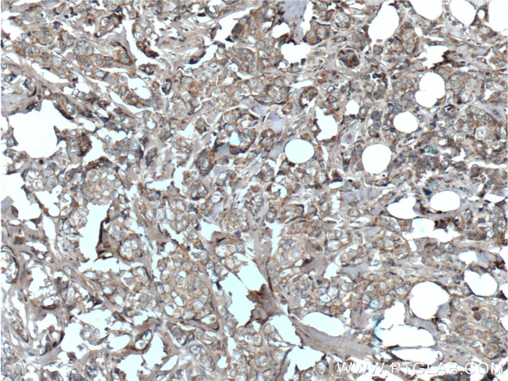 Immunohistochemistry (IHC) staining of human breast cancer tissue using hCG Beta Polyclonal antibody (11615-1-AP)