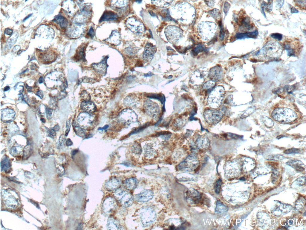 Immunohistochemistry (IHC) staining of human breast cancer tissue using hCG Beta Polyclonal antibody (11615-1-AP)