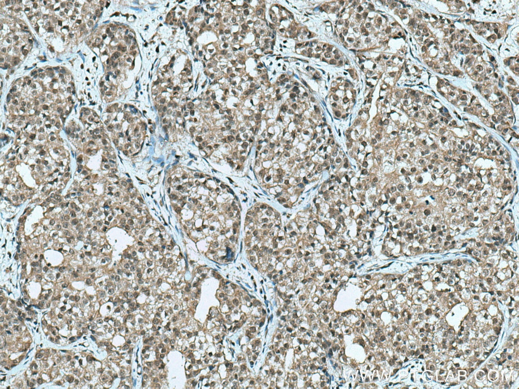 Immunohistochemistry (IHC) staining of human breast cancer tissue using CGGBP1 Polyclonal antibody (10716-1-AP)