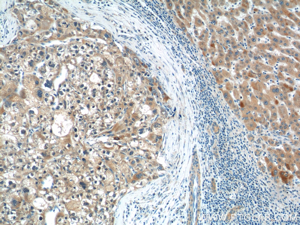 Immunohistochemistry (IHC) staining of human liver cancer tissue using CGNL1 Polyclonal antibody (18031-1-AP)