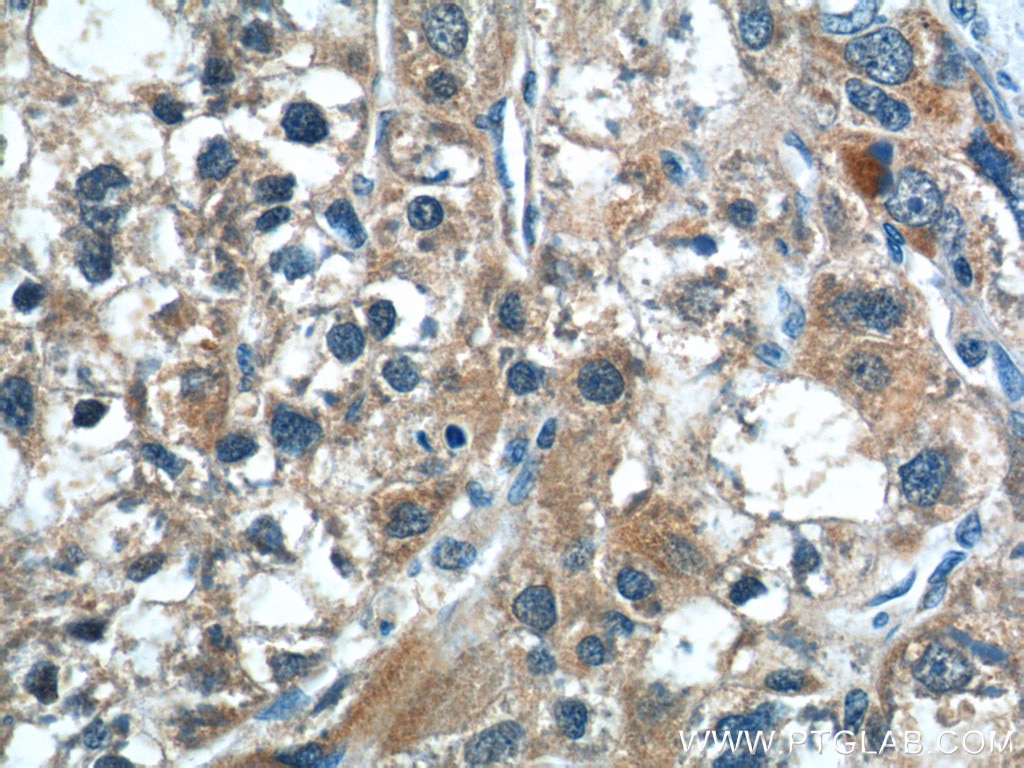 Immunohistochemistry (IHC) staining of human liver cancer tissue using CGNL1 Polyclonal antibody (18031-1-AP)