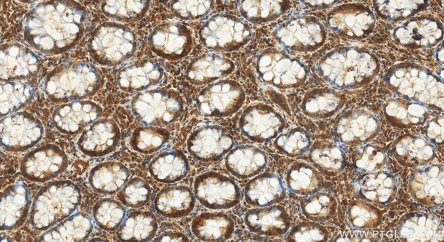 Immunohistochemistry (IHC) staining of human colon cancer tissue using CHAF1A Polyclonal antibody (17037-1-AP)