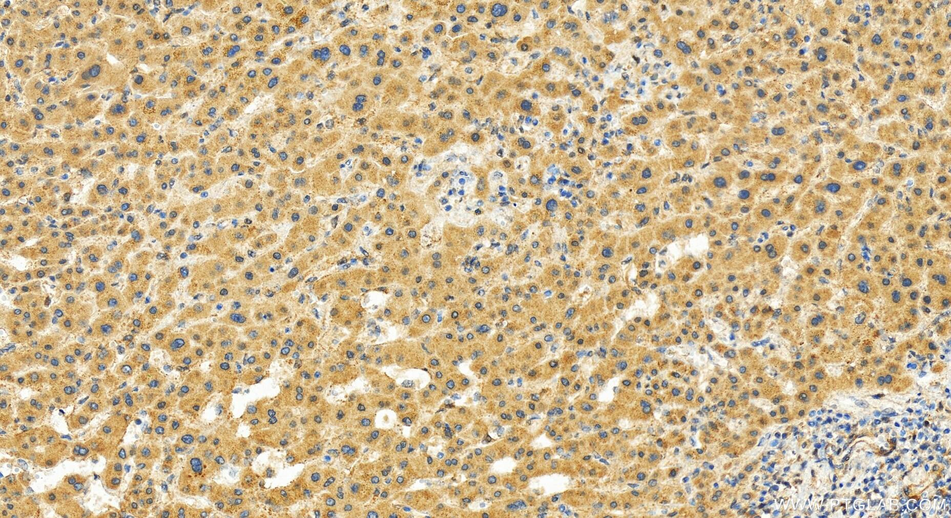 Immunohistochemistry (IHC) staining of human intrahepatic cholangiocarcinoma tissue using CHAF1B Polyclonal antibody (27633-1-AP)
