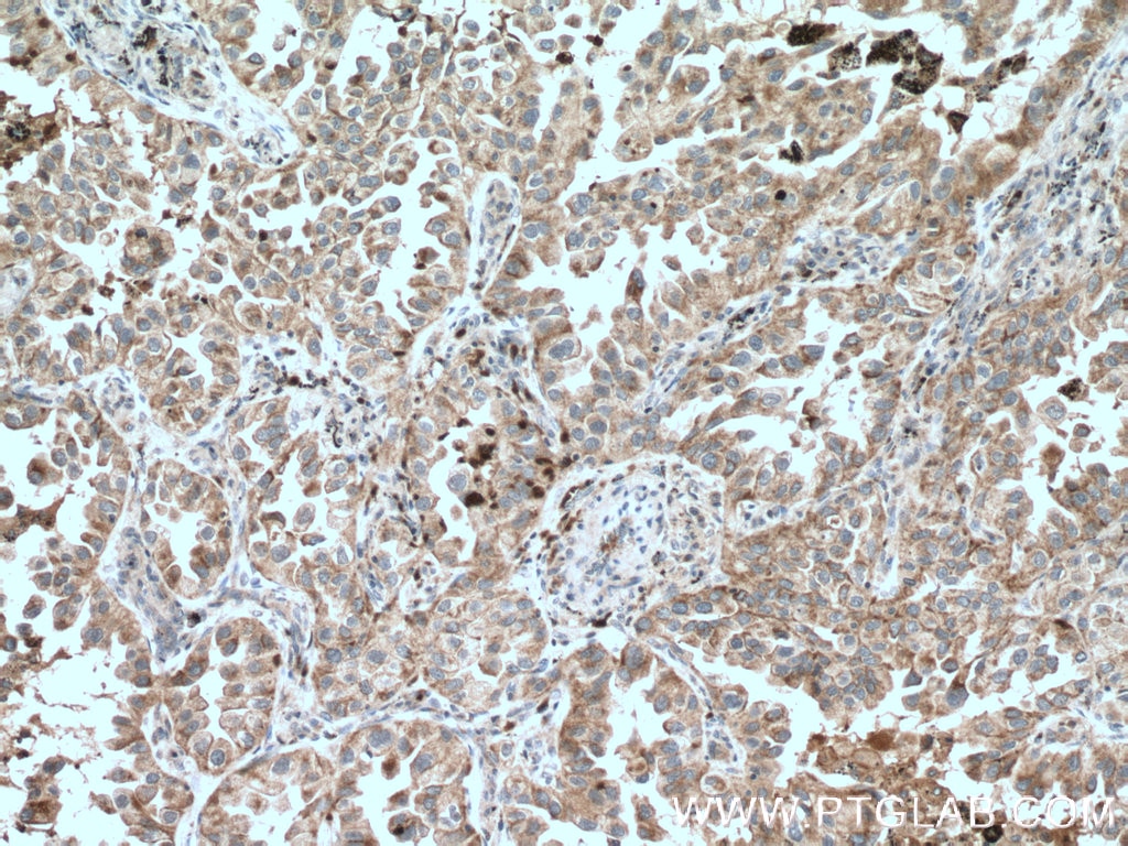 Immunohistochemistry (IHC) staining of human lung cancer tissue using CHAT Polyclonal antibody (20747-1-AP)