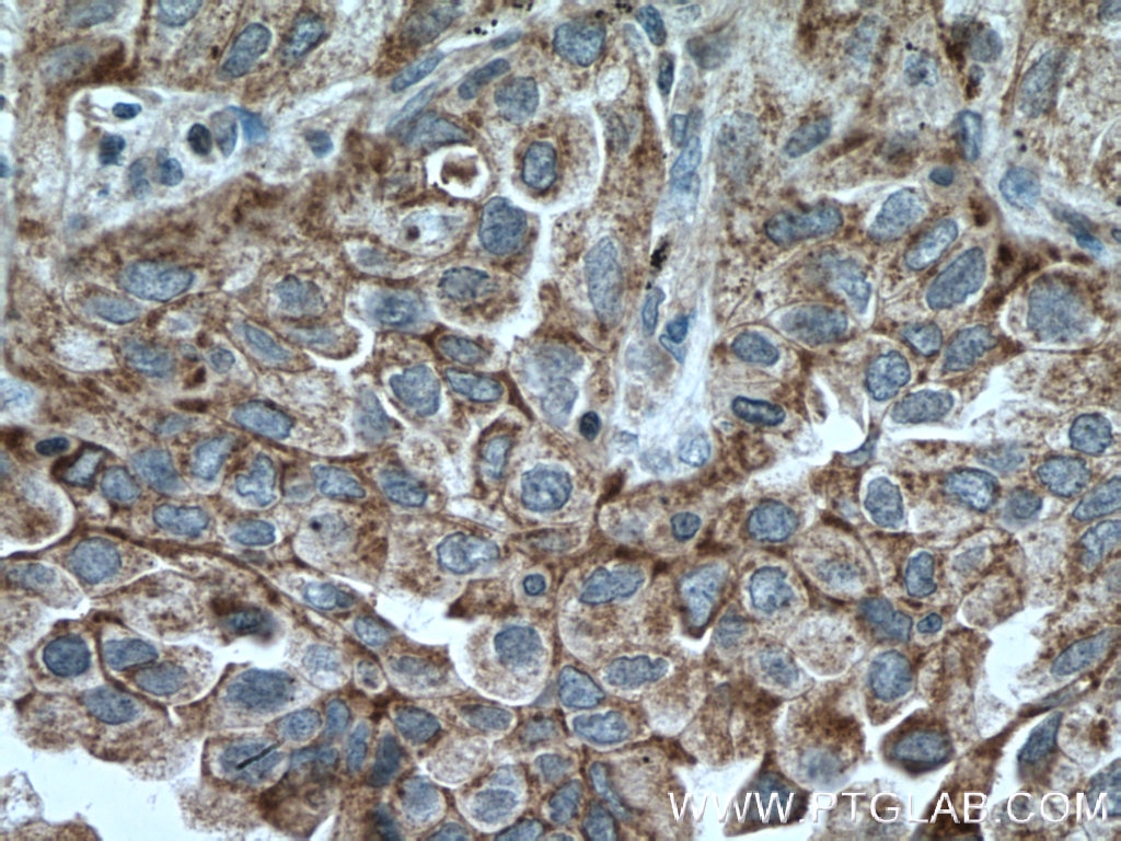 Immunohistochemistry (IHC) staining of human lung cancer tissue using CHAT Polyclonal antibody (20747-1-AP)