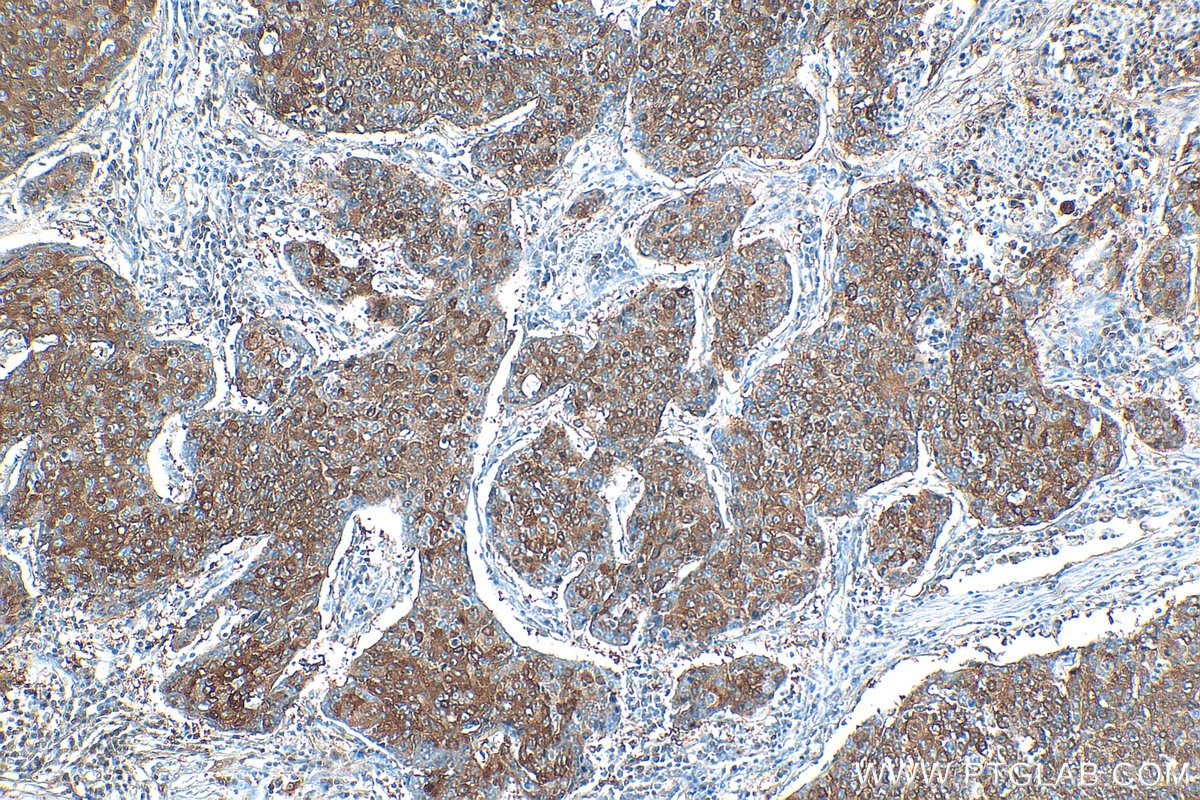 Immunohistochemistry (IHC) staining of human lung cancer tissue using CHAT Polyclonal antibody (20747-1-AP)
