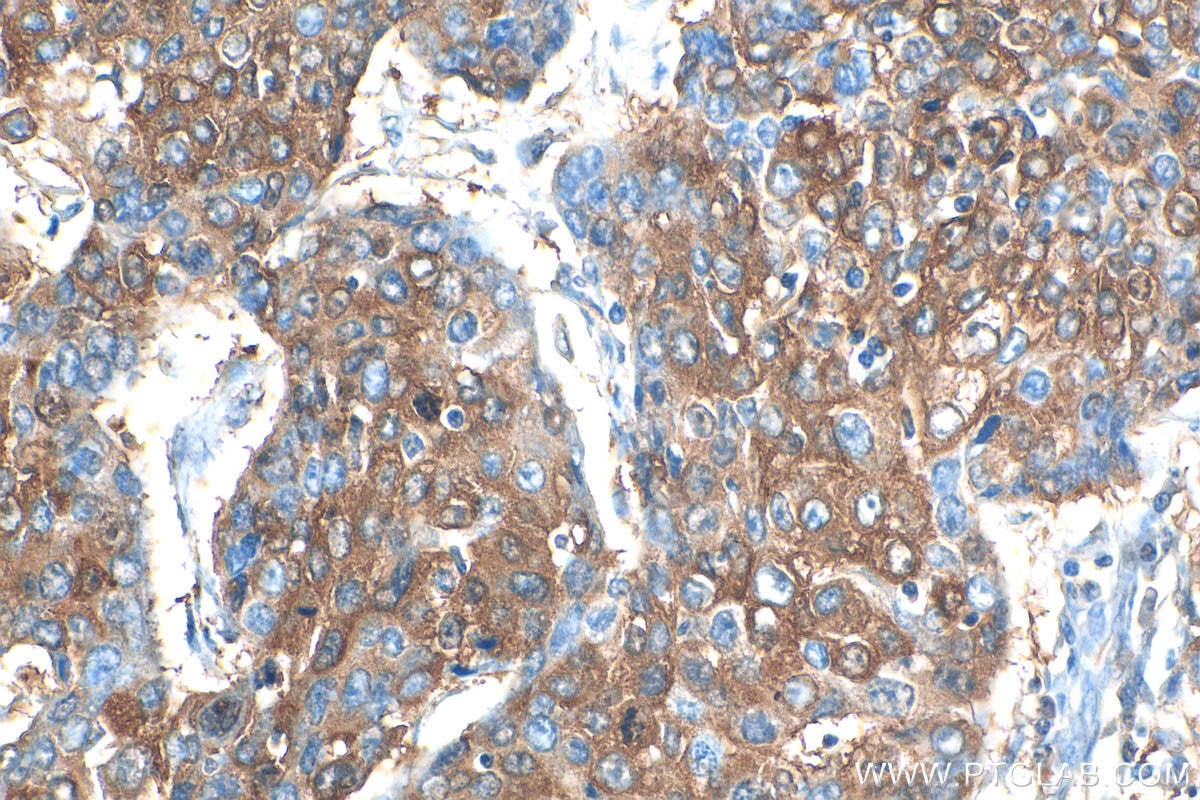 Immunohistochemistry (IHC) staining of human lung cancer tissue using CHAT Polyclonal antibody (20747-1-AP)