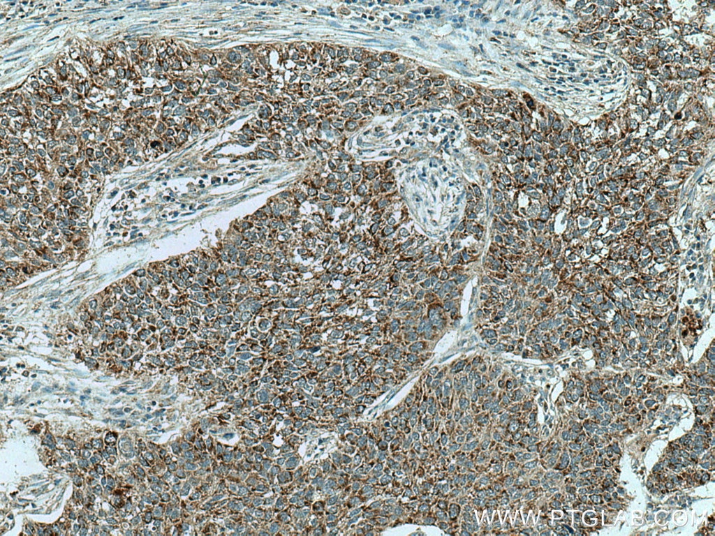 Immunohistochemistry (IHC) staining of human lung cancer tissue using CHCHD2 Polyclonal antibody (19424-1-AP)