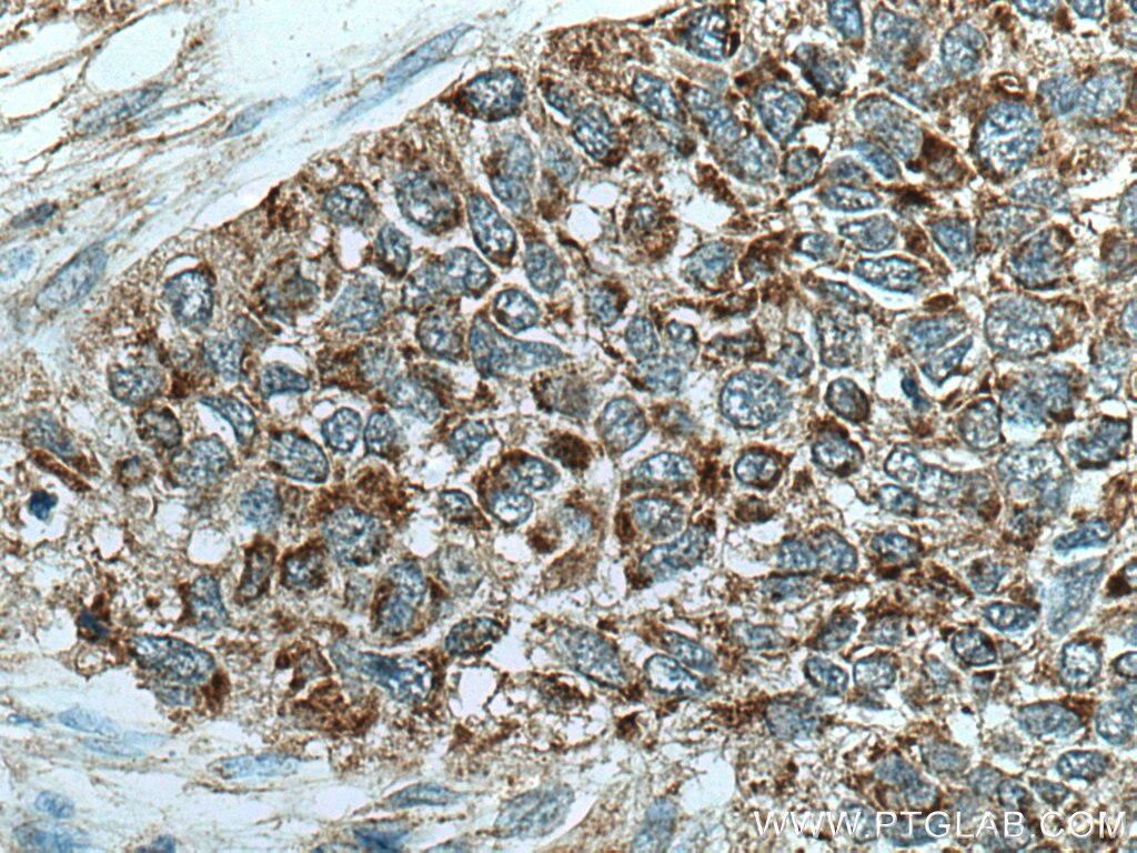 Immunohistochemistry (IHC) staining of human lung cancer tissue using CHCHD2 Polyclonal antibody (19424-1-AP)