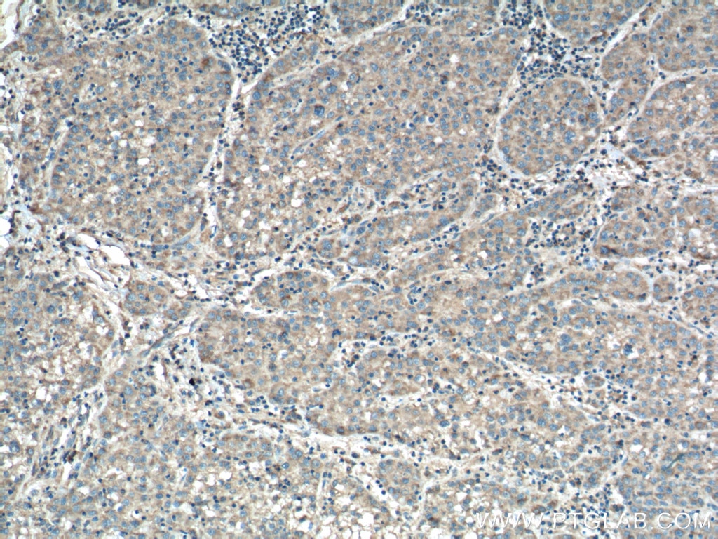 Immunohistochemistry (IHC) staining of human liver cancer tissue using CHCHD2 Monoclonal antibody (66302-1-Ig)