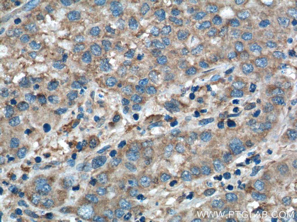 Immunohistochemistry (IHC) staining of human liver cancer tissue using CHCHD2 Monoclonal antibody (66302-1-Ig)