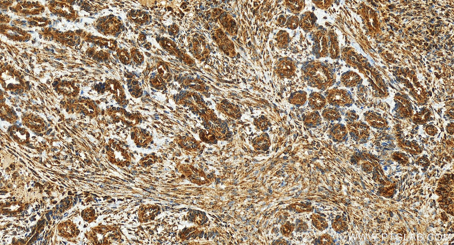 Immunohistochemistry (IHC) staining of human ovarian  cancer using CHCHD5 Polyclonal antibody (25711-1-AP)