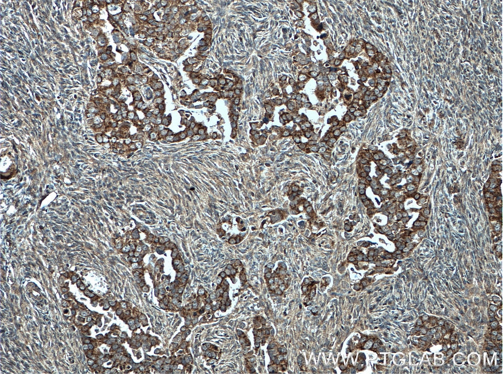 Immunohistochemistry (IHC) staining of human ovary tumor tissue using CHCHD5 Monoclonal antibody (66584-1-Ig)