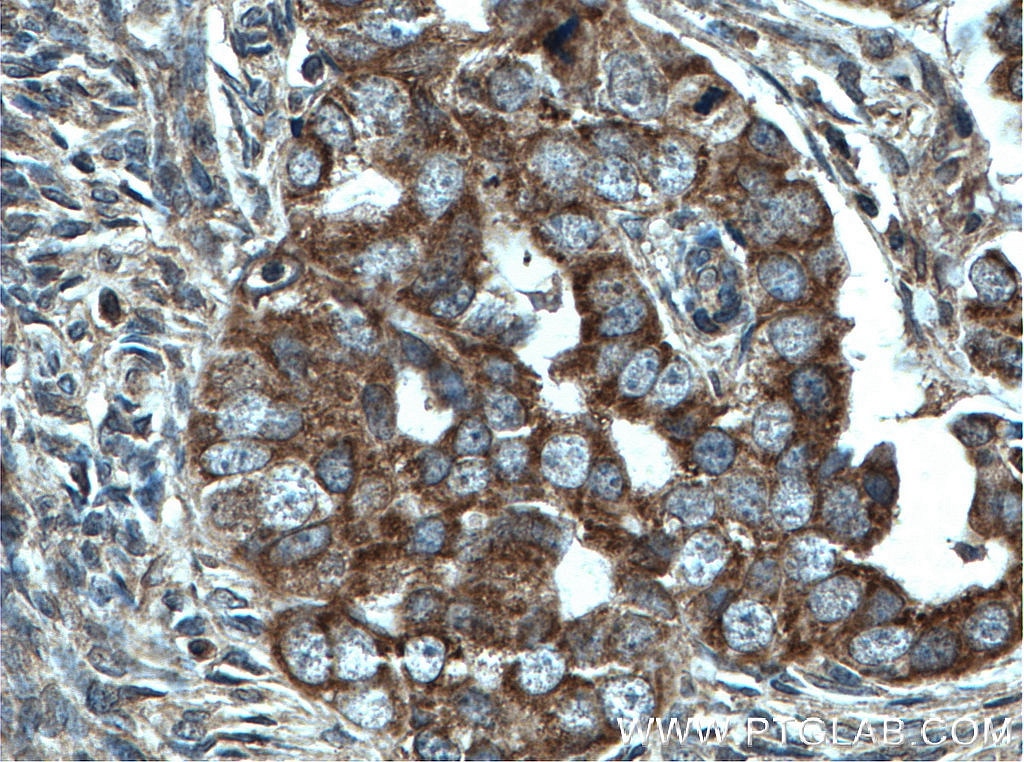 Immunohistochemistry (IHC) staining of human ovary tumor tissue using CHCHD5 Monoclonal antibody (66584-1-Ig)