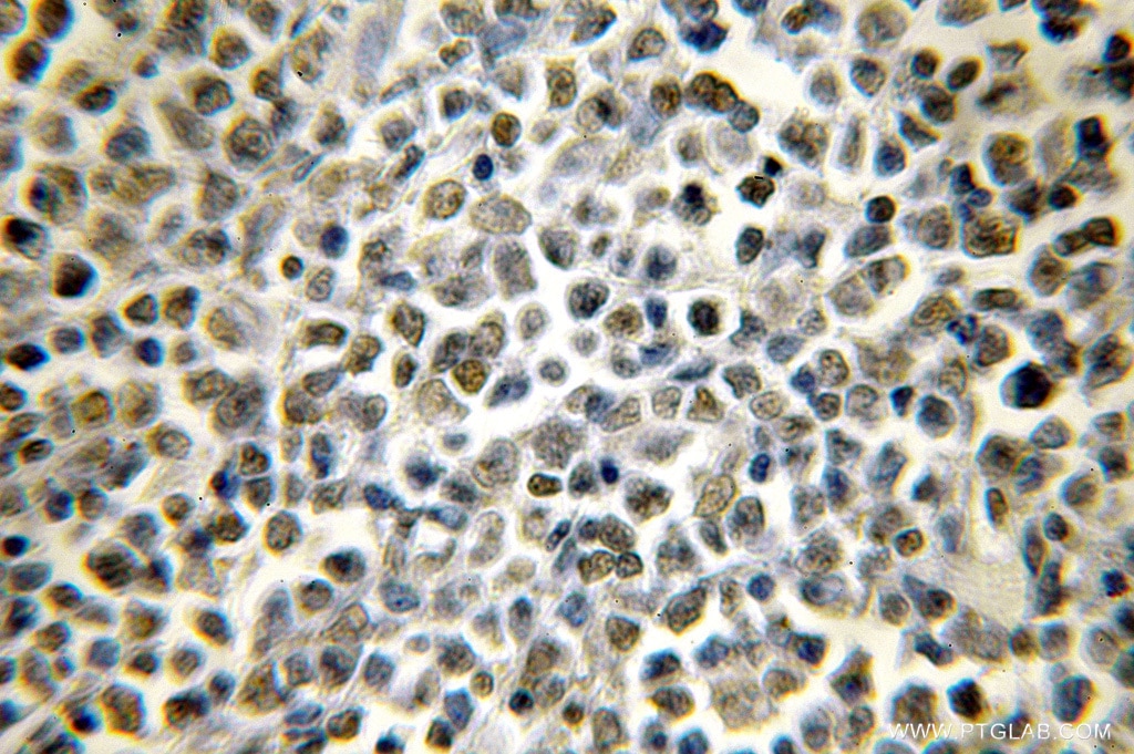 Immunohistochemistry (IHC) staining of human lymphoma tissue using CHD2 Polyclonal antibody (12311-1-AP)
