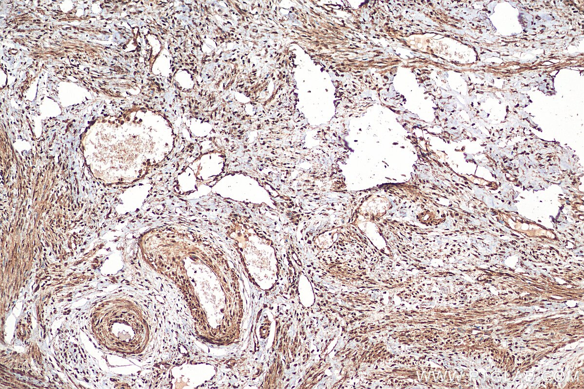 Immunohistochemistry (IHC) staining of human cervical cancer tissue using CHD4 Polyclonal antibody (14173-1-AP)