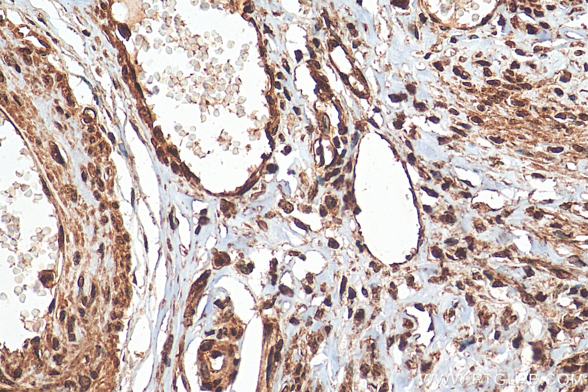 Immunohistochemistry (IHC) staining of human cervical cancer tissue using CHD4 Polyclonal antibody (14173-1-AP)