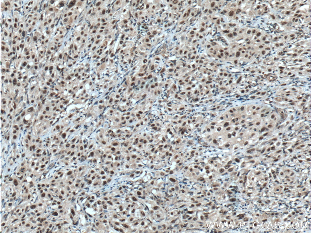 IHC staining of human cervical cancer using 66222-1-Ig
