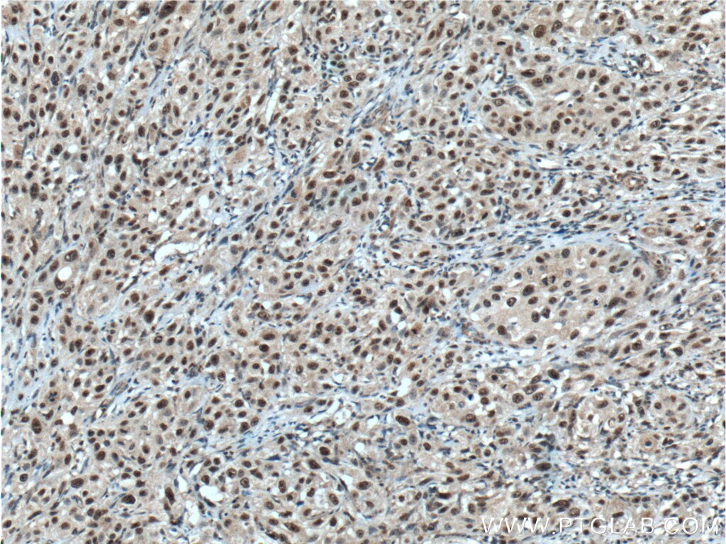 Immunohistochemistry (IHC) staining of human cervical cancer tissue using CHD4 Monoclonal antibody (66222-1-Ig)