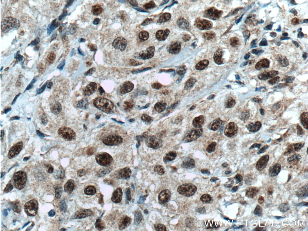 Immunohistochemistry (IHC) staining of human cervical cancer tissue using CHD4 Monoclonal antibody (66222-1-Ig)