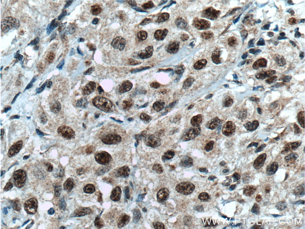 IHC staining of human cervical cancer using 66222-1-Ig