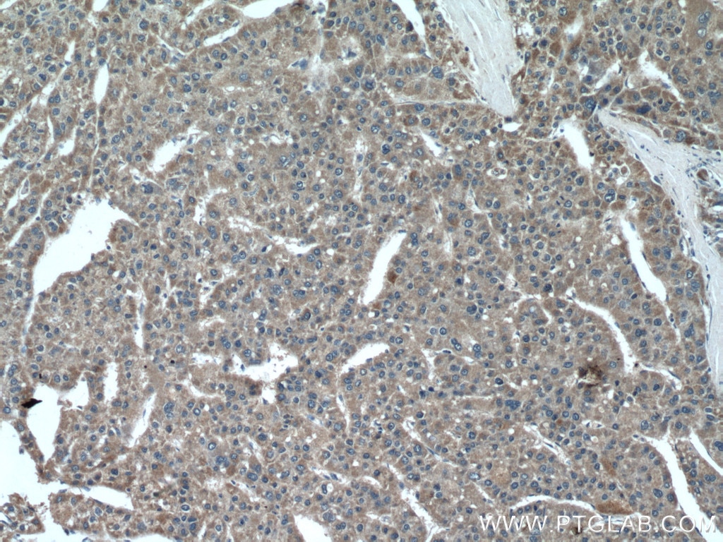 Immunohistochemistry (IHC) staining of human liver cancer tissue using CHDH Polyclonal antibody (17356-1-AP)