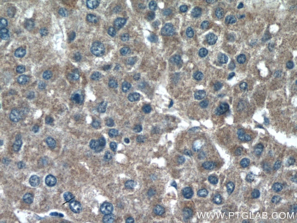 Immunohistochemistry (IHC) staining of human liver cancer tissue using CHDH Polyclonal antibody (17356-1-AP)