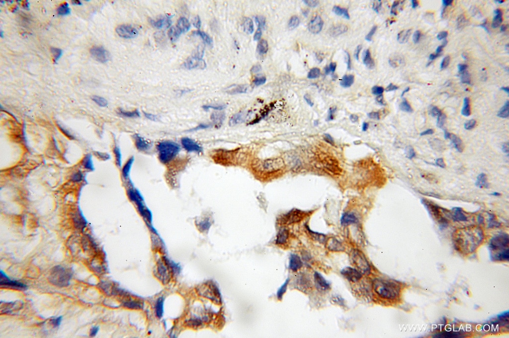 Immunohistochemistry (IHC) staining of human lung cancer tissue using CHFR Polyclonal antibody (12169-1-AP)