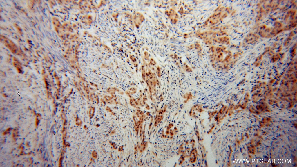 Immunohistochemistry (IHC) staining of human endometrial cancer tissue using CHFR Polyclonal antibody (12169-1-AP)