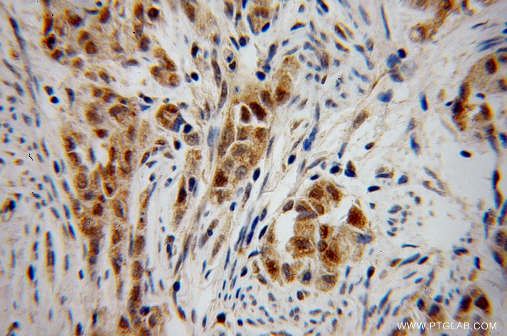 Immunohistochemistry (IHC) staining of human endometrial cancer tissue using CHFR Polyclonal antibody (12169-1-AP)