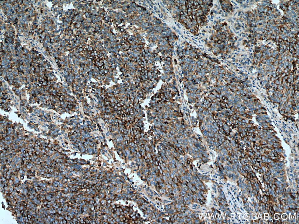 Immunohistochemistry (IHC) staining of human lung cancer tissue using Chromogranin A Polyclonal antibody (10529-1-AP)