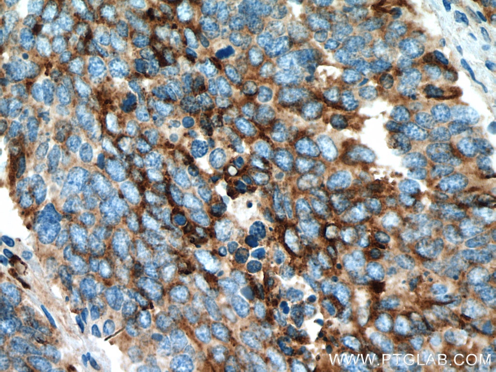 IHC staining of human lung cancer using 10529-1-AP