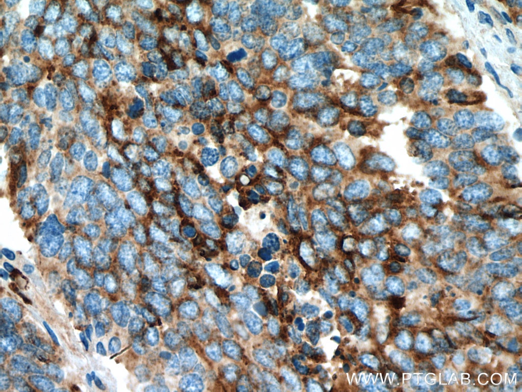 Immunohistochemistry (IHC) staining of human lung cancer tissue using Chromogranin A Polyclonal antibody (10529-1-AP)