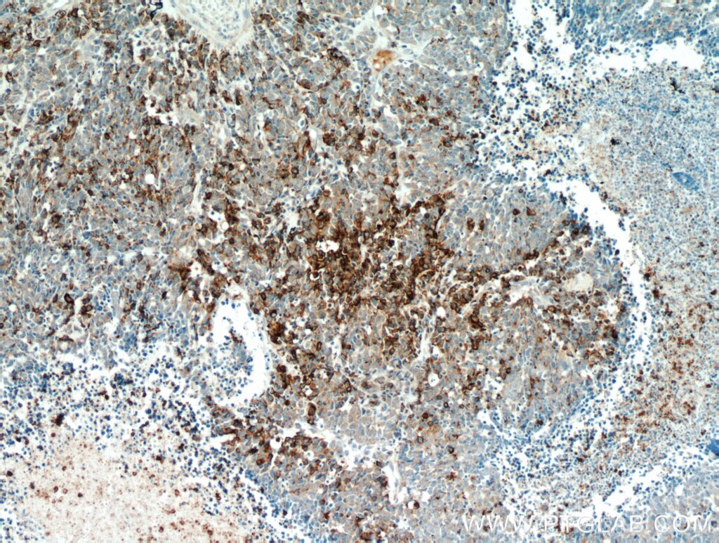 Immunohistochemistry (IHC) staining of human lung cancer tissue using Chromogranin A Polyclonal antibody (10529-1-AP)