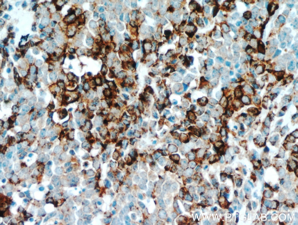 Immunohistochemistry (IHC) staining of human lung cancer tissue using Chromogranin A Polyclonal antibody (10529-1-AP)