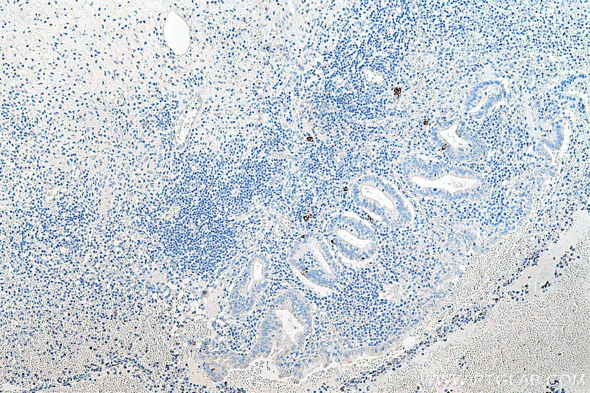 IHC staining of human appendicitis using 23342-1-AP