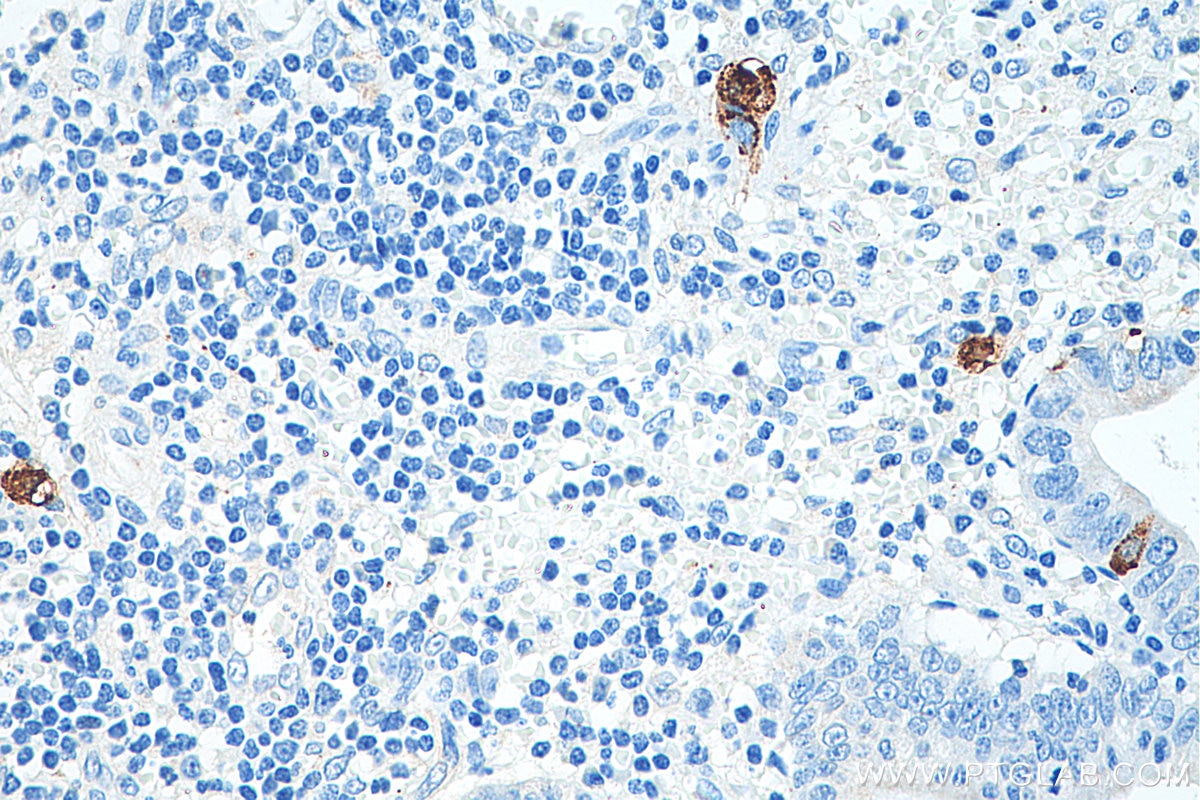 Immunohistochemistry (IHC) staining of human appendicitis tissue using Chromogranin A Polyclonal antibody (23342-1-AP)