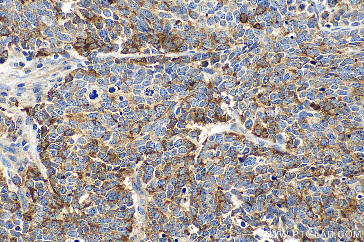 Immunohistochemistry (IHC) staining of human lung cancer tissue using Chromogranin A Polyclonal antibody (23342-1-AP)