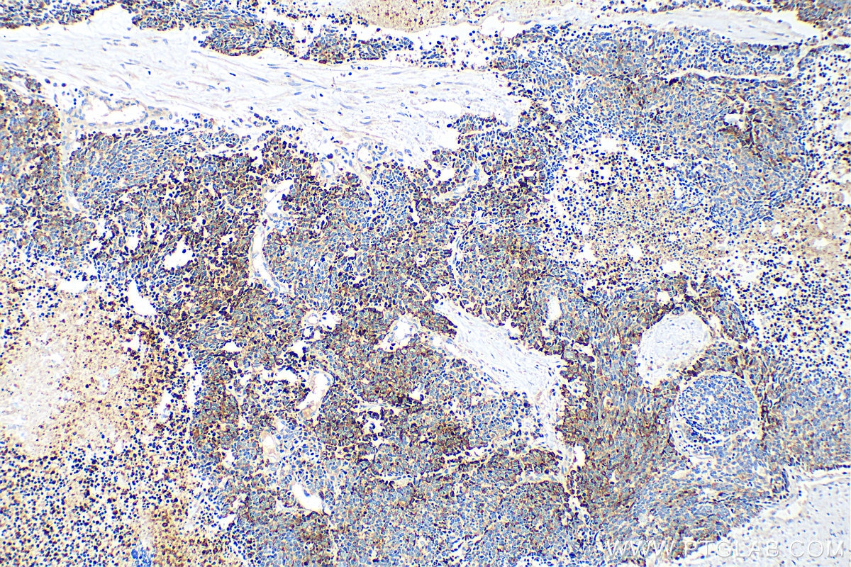 Immunohistochemistry (IHC) staining of human lung cancer tissue using Chromogranin A Polyclonal antibody (23342-1-AP)