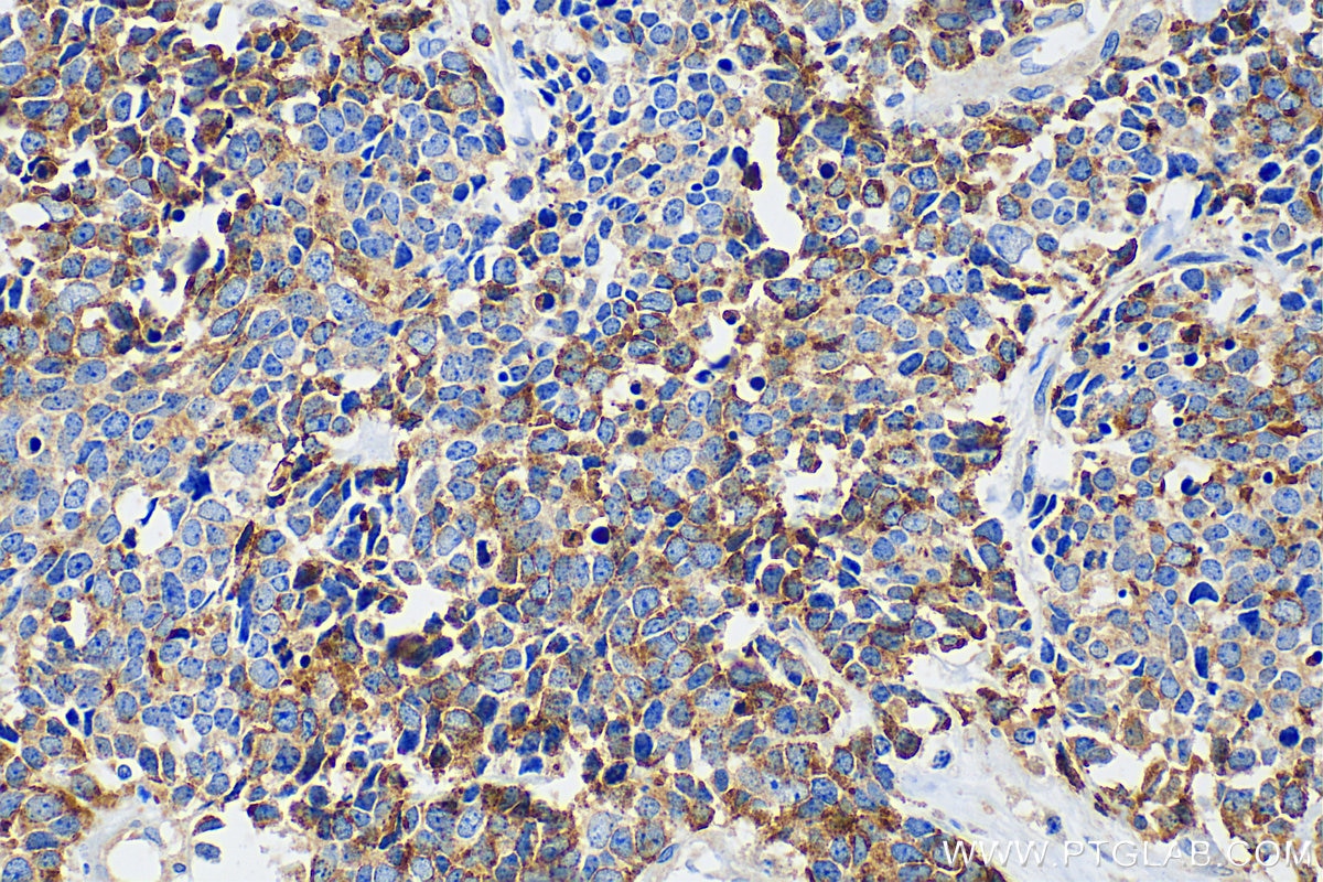 Immunohistochemistry (IHC) staining of human lung cancer tissue using Chromogranin A Polyclonal antibody (23342-1-AP)