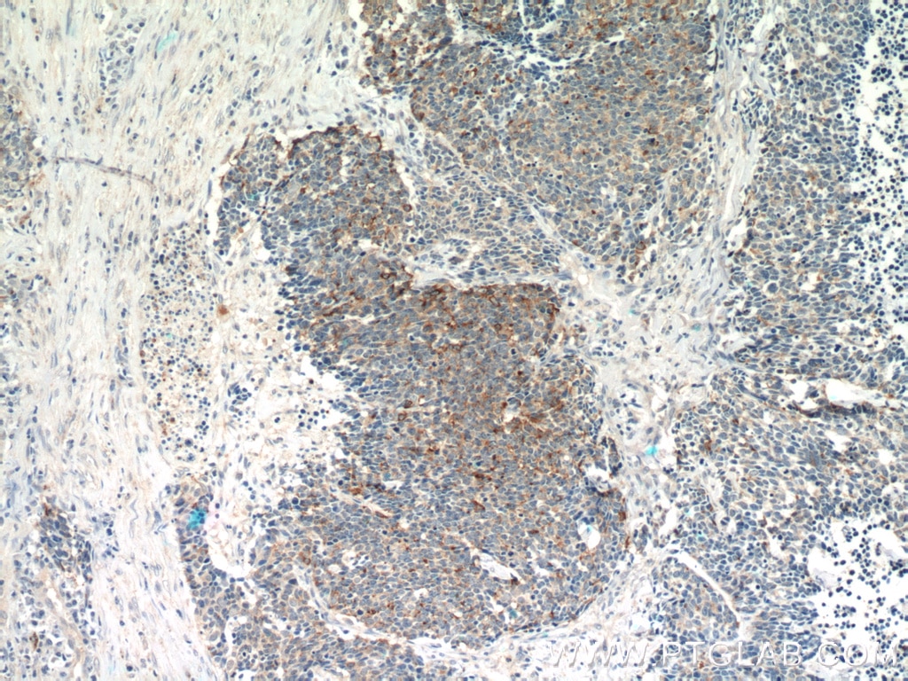 Immunohistochemistry (IHC) staining of human lung cancer tissue using Chromogranin A Polyclonal antibody (23342-1-AP)