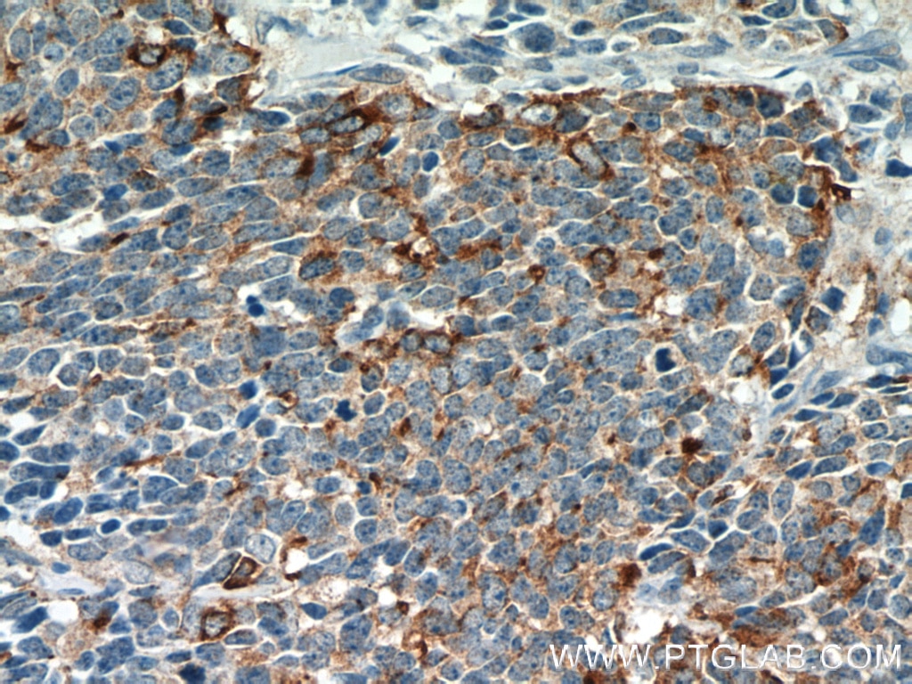 Immunohistochemistry (IHC) staining of human lung cancer tissue using Chromogranin A Polyclonal antibody (23342-1-AP)