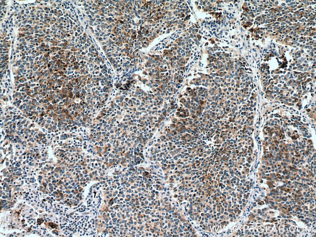 Immunohistochemistry (IHC) staining of human lung cancer tissue using Chromogranin A Monoclonal antibody (60135-1-Ig)
