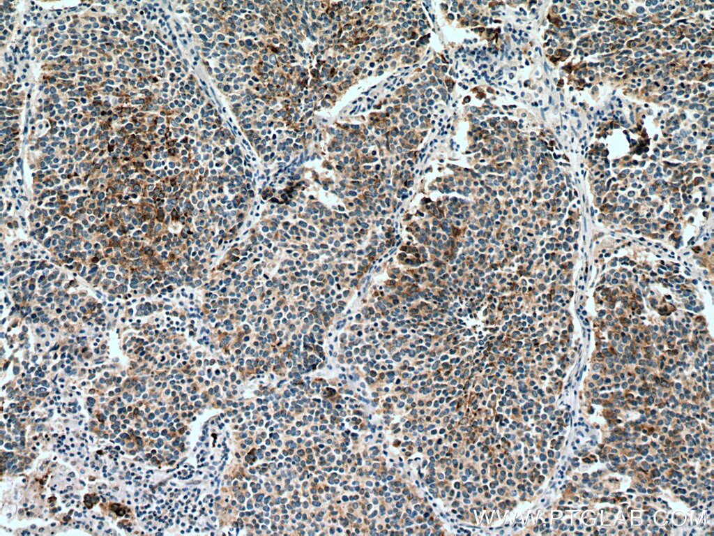 IHC staining of human lung cancer using 60135-1-Ig