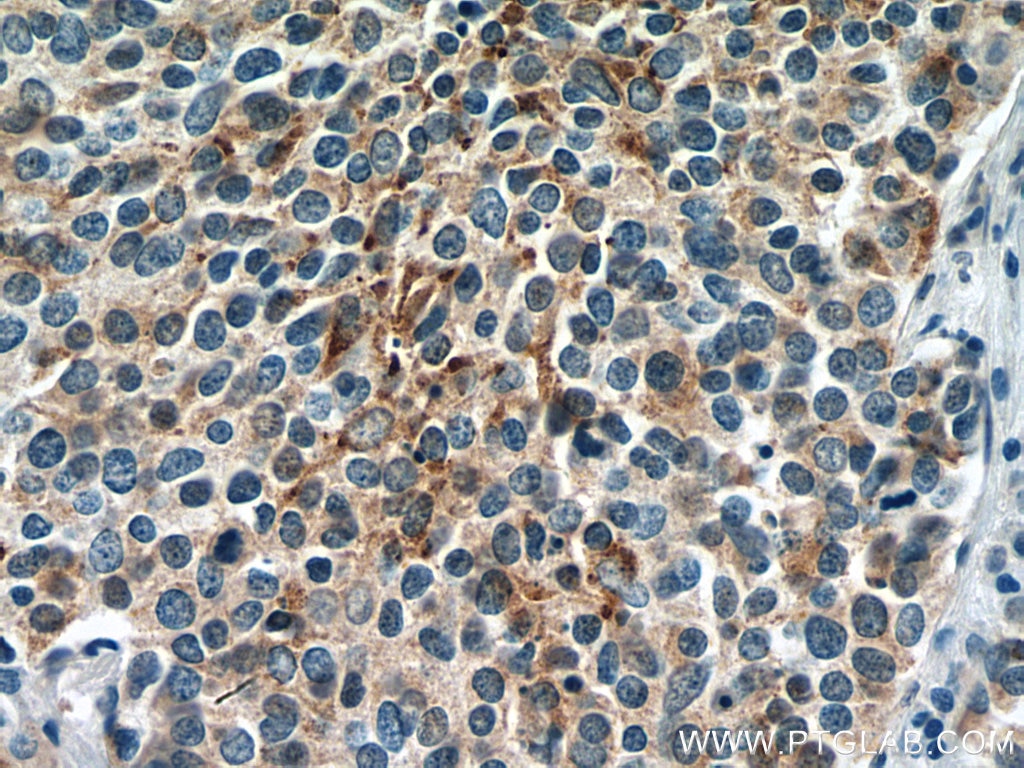 Immunohistochemistry (IHC) staining of human lung cancer tissue using Chromogranin A Monoclonal antibody (60135-1-Ig)